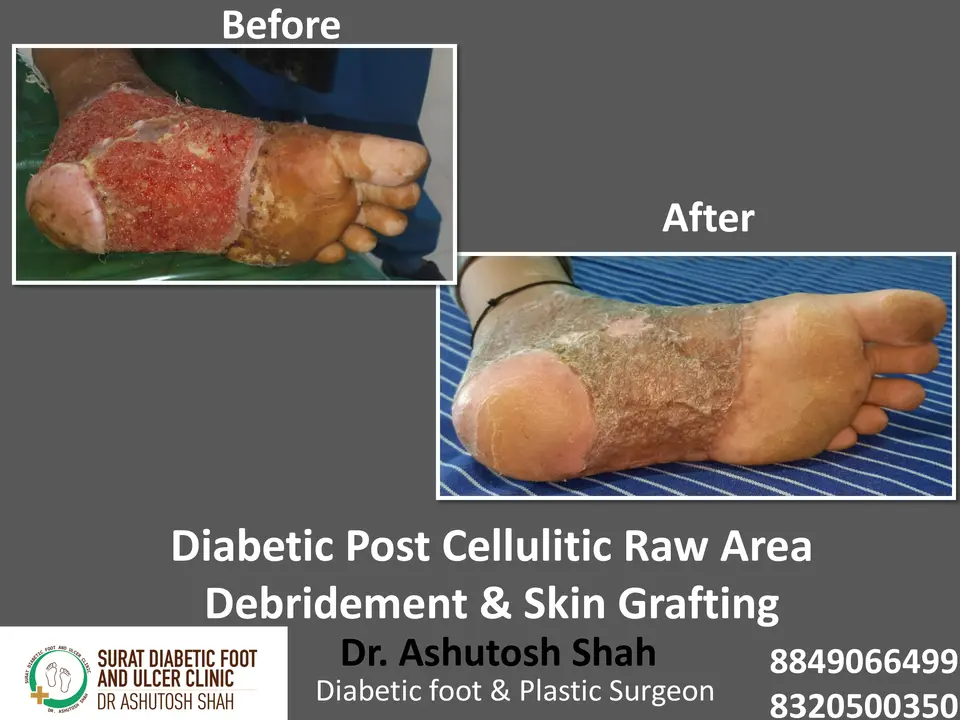 Diabetic Cellulitis and Coverage.pptx-18.webp